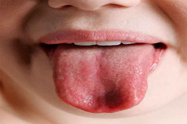 इन 7 कारणों से होता है मुंह में छाले, 5 तरीकों से तुरंत पाएं छुटकारा 